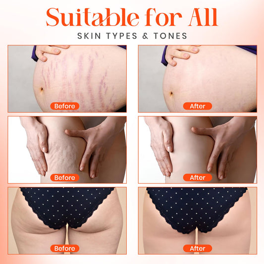 Stretch mark remover oil